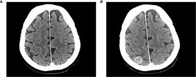 Case Report: Clinical Experience With Avelumab in Patients With Metastatic Merkel Cell Carcinoma and Brain Metastases Treated in Europe